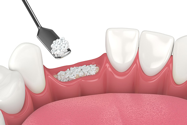 A 3D rendering of a bone graft treatment