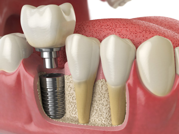 Diagram of dental implant into a jawbone at Surprise Oral & Implant Surgery in Surprise, AZ