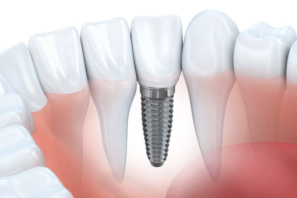 Diagram of dental implant in lower jaw Diagram of dental implant in lower jaw