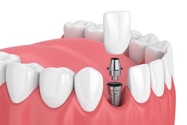 Dental implants from Surprise Oral & Implant Surgery in Surprise, AZ