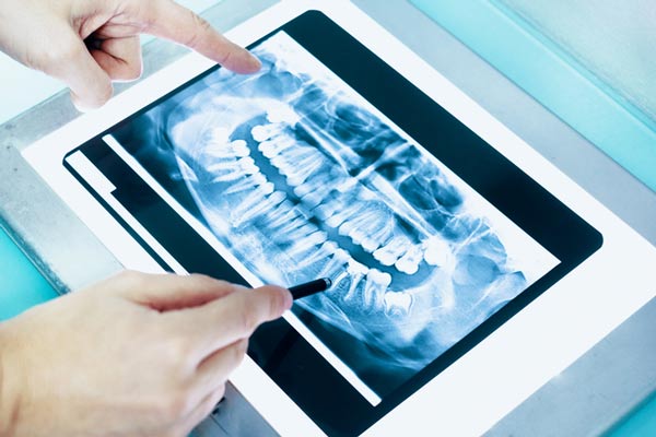 Dental x-ray of a full mouth at Surprise Oral & Implant Surgery in Surprise, AZ