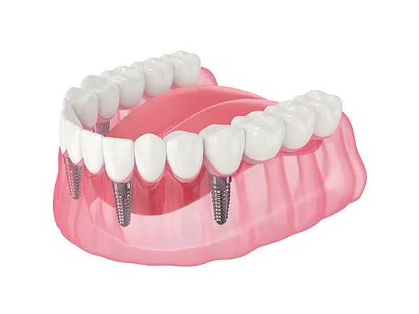 3D rendering of a dental implant bridge replacing the entire lower row of teeth