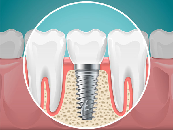 Diagram of a tooth replaced with a dental implant Surprise Oral & Implant Surgery in Surprise, AZ