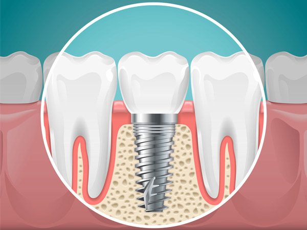 Diagram of a tooth replaced with a dental implant Surprise Oral & Implant Surgery in Surprise, AZ Diagram of a tooth replaced with a dental implant Surprise Oral & Implant Surgery in Surprise, AZ