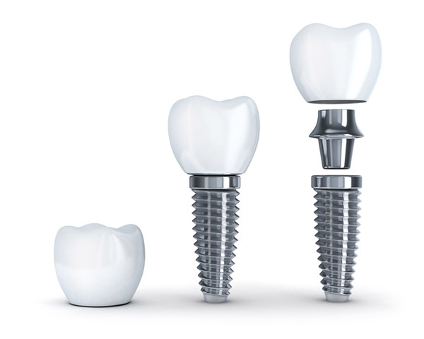 Diagram of dental implant with post from Surprise Oral & Implant Surgery in Surprise, AZ