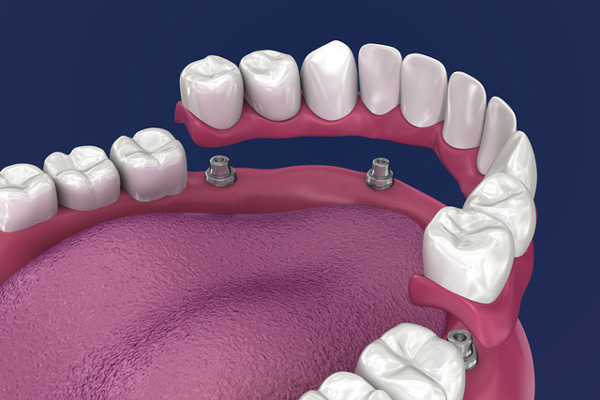 3D rendering of overdentures in a mouth from Surprise Oral & Implant Surgery in Surprise, AZ