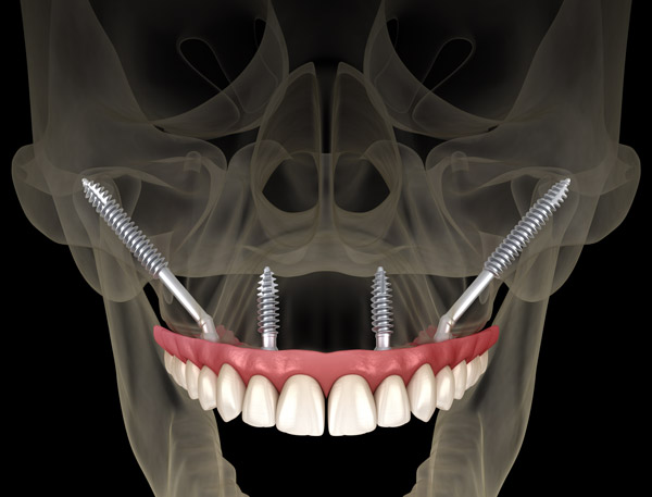 3D x-ray rendering of zygomatic implants placed in the upper jaw at Surprise Oral & Implant Surgery in Surprise, AZ