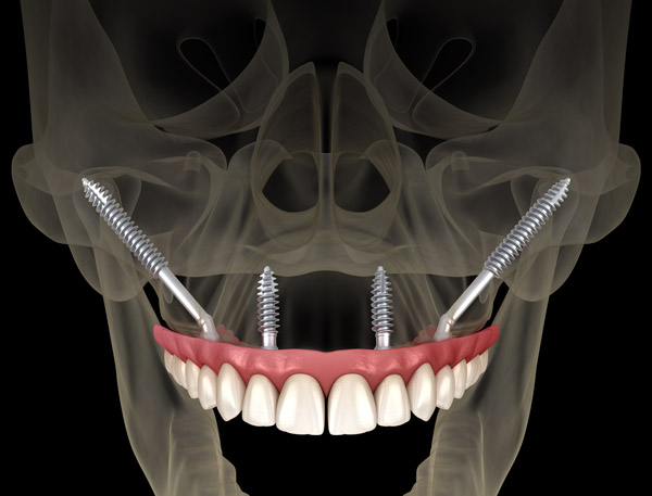 Digital model of zygomatic implants at Surprise Oral & Implant Surgery in Surprise, AZ