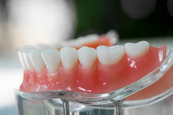 Close-up of an All-on-4 dental implant model demonstrating how artificial teeth are secured with implants.